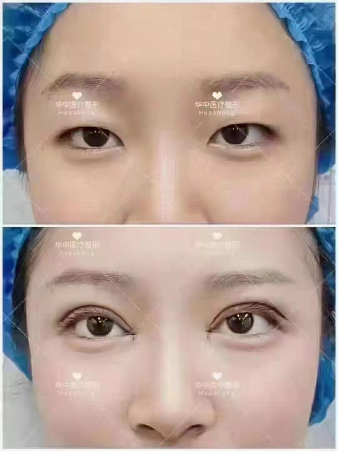 割双眼皮